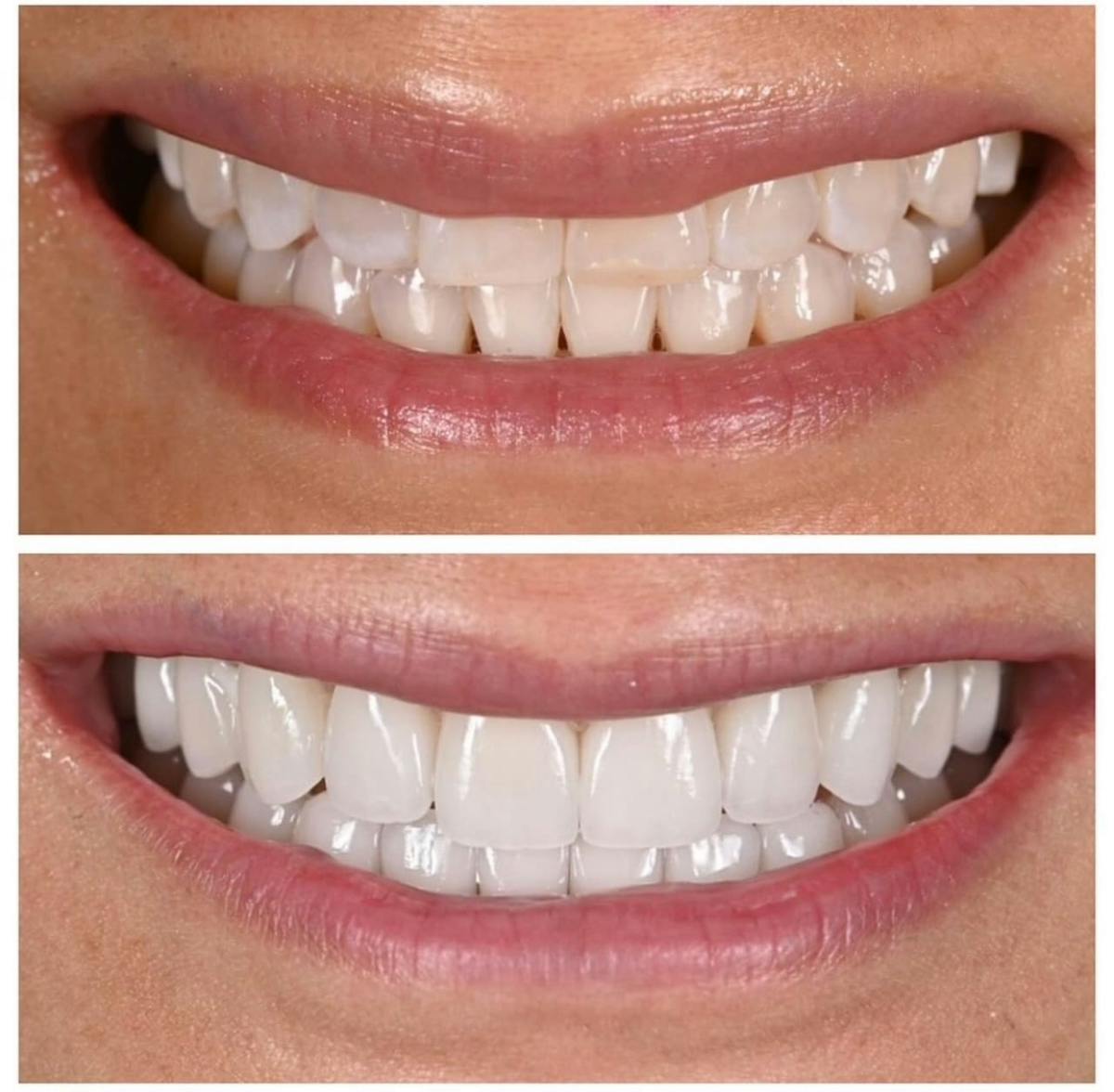 Smile Makeover Before & After Gallery - Patient 324202 - Image 1