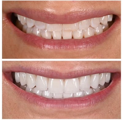 Smile Makeover Before & After Gallery - Patient 324202 - Image 1