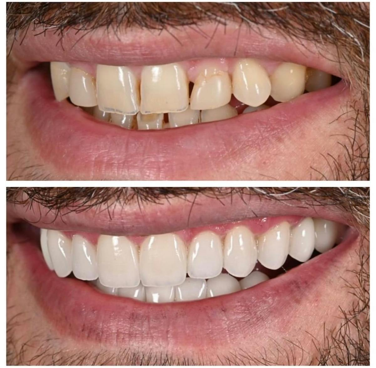 Smile Makeover Before & After Gallery - Patient 252789 - Image 3