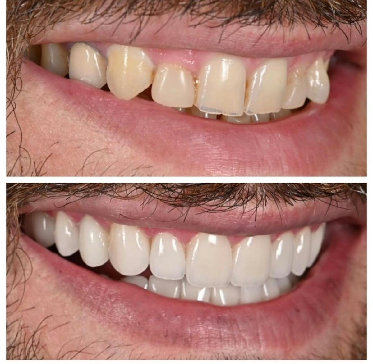 Smile Makeover Before & After Gallery - Patient 252789 - Image 2