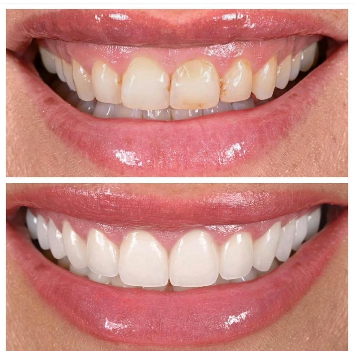 Smile Makeover Before & After Gallery - Patient 207038 - Image 1