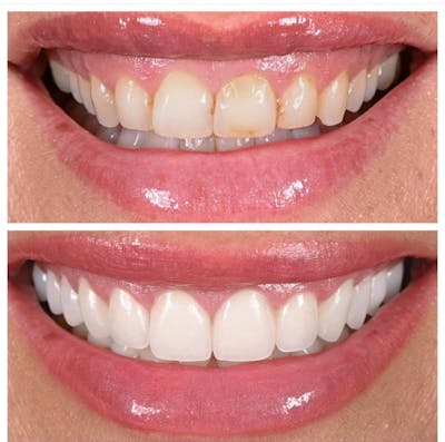 Smile Makeover Before & After Gallery - Patient 207038 - Image 1