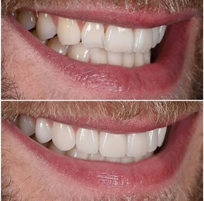 Smile Makeover Before & After Gallery - Patient 399019 - Image 1