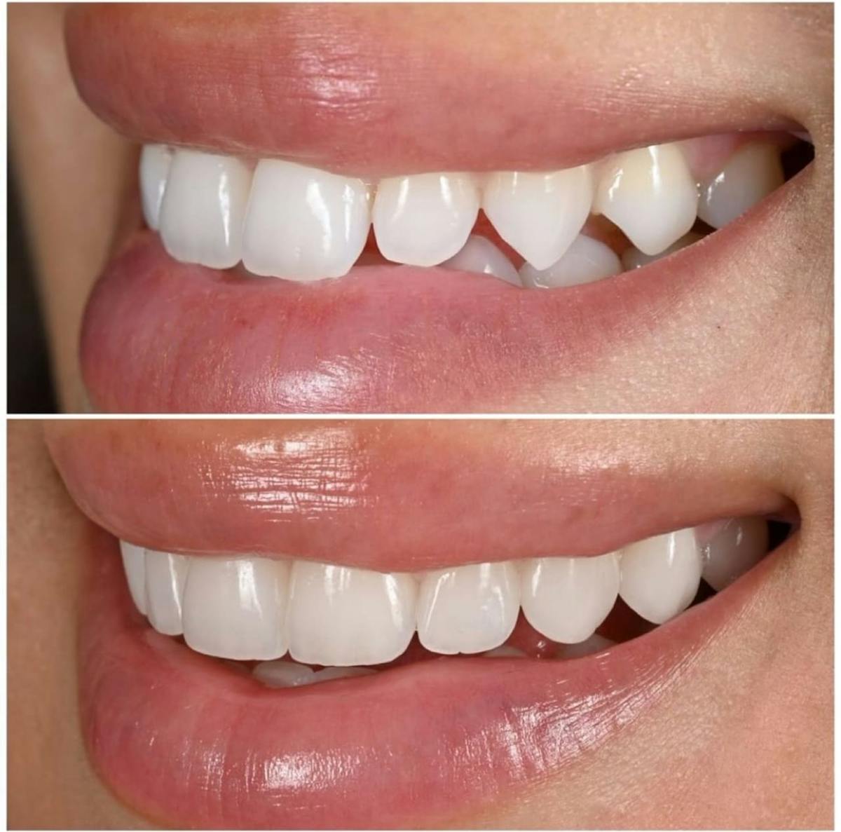 Smile Makeover Before & After Gallery - Patient 267302 - Image 2