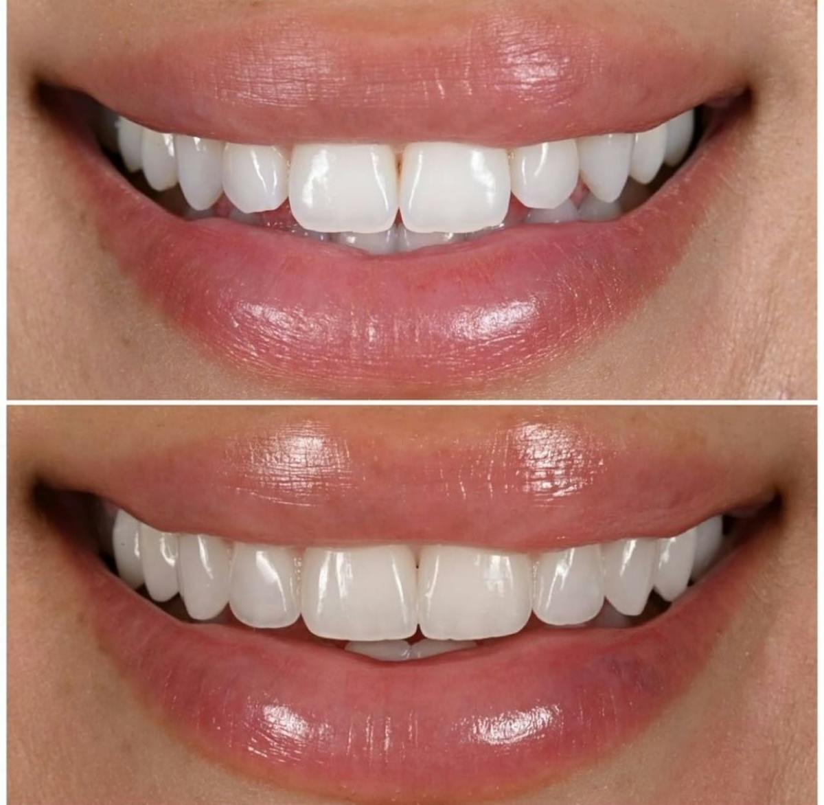 Smile Makeover Before & After Gallery - Patient 267302 - Image 1