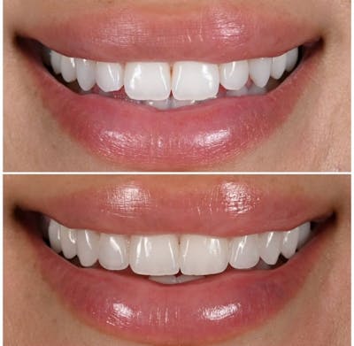 Smile Makeover Before & After Gallery - Patient 267302 - Image 1