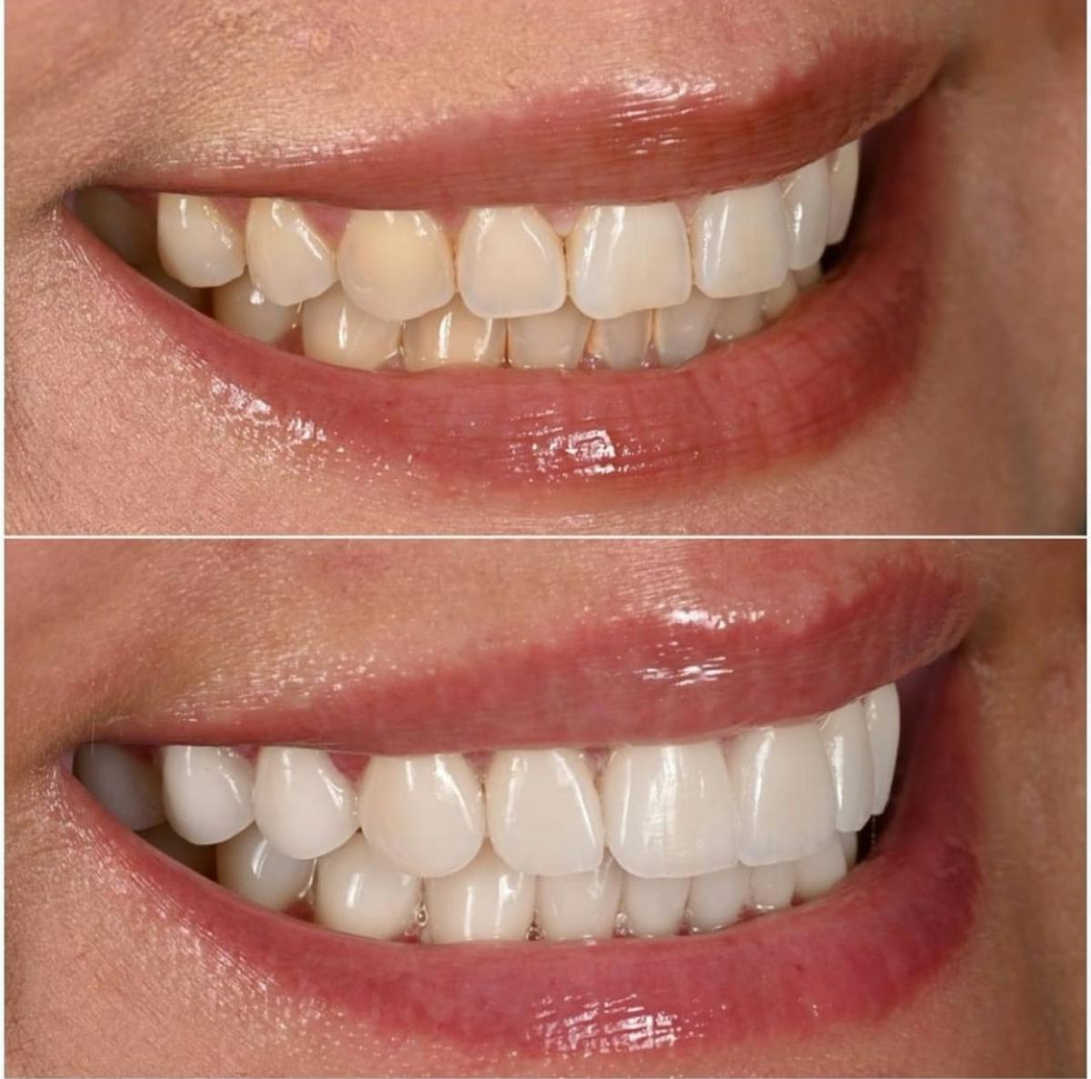 Smile Makeover Before & After Gallery - Patient 334037 - Image 3