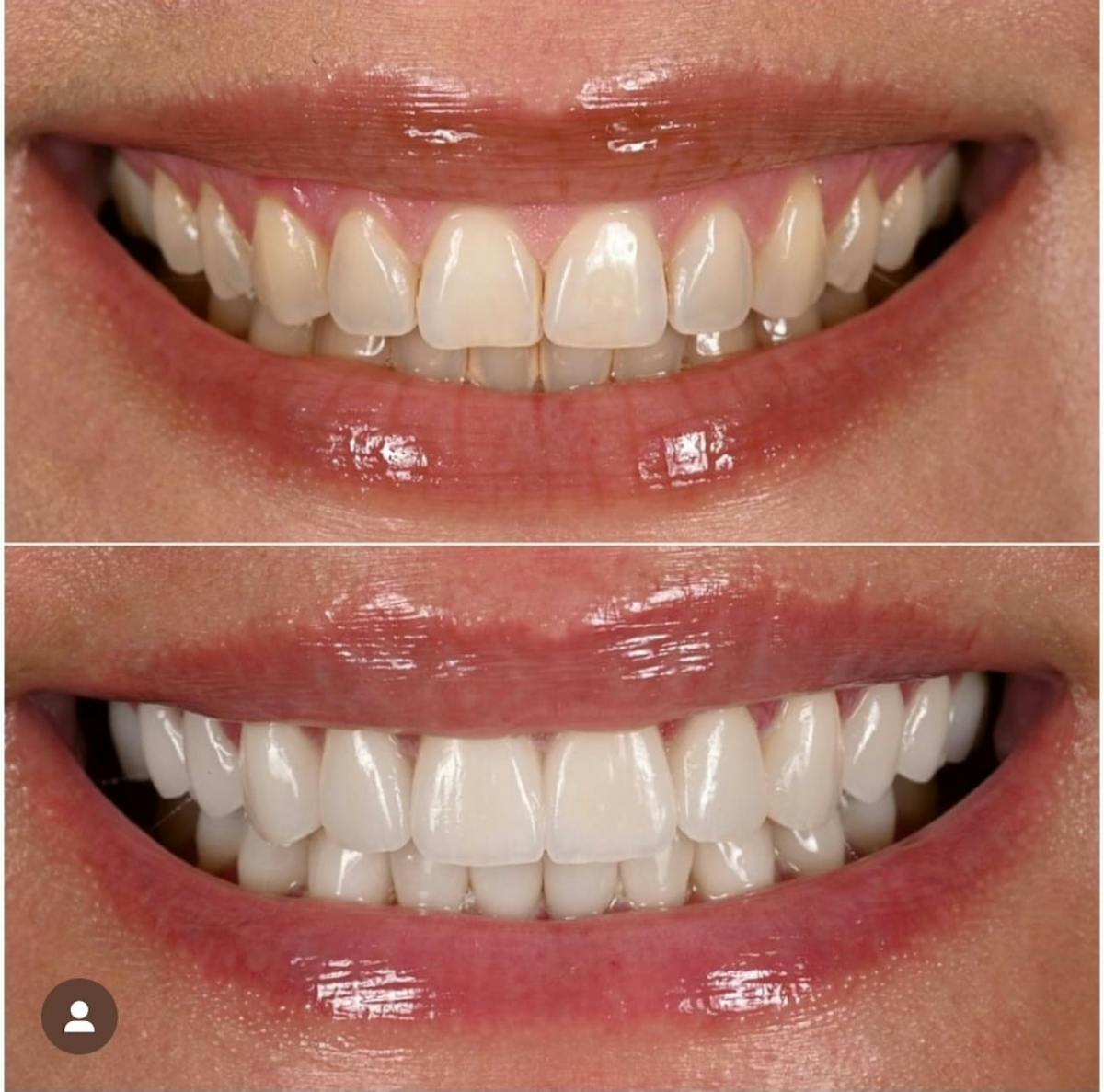 Smile Makeover Before & After Gallery - Patient 334037 - Image 2