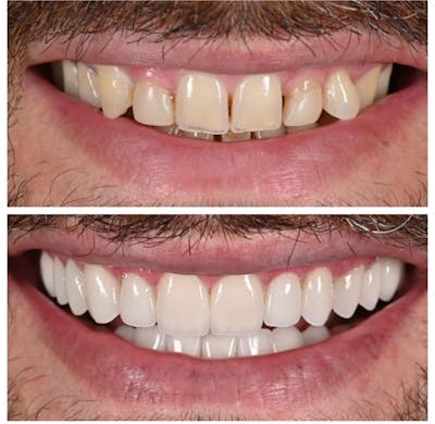 Smile Makeover Before & After Gallery - Patient 252789 - Image 1