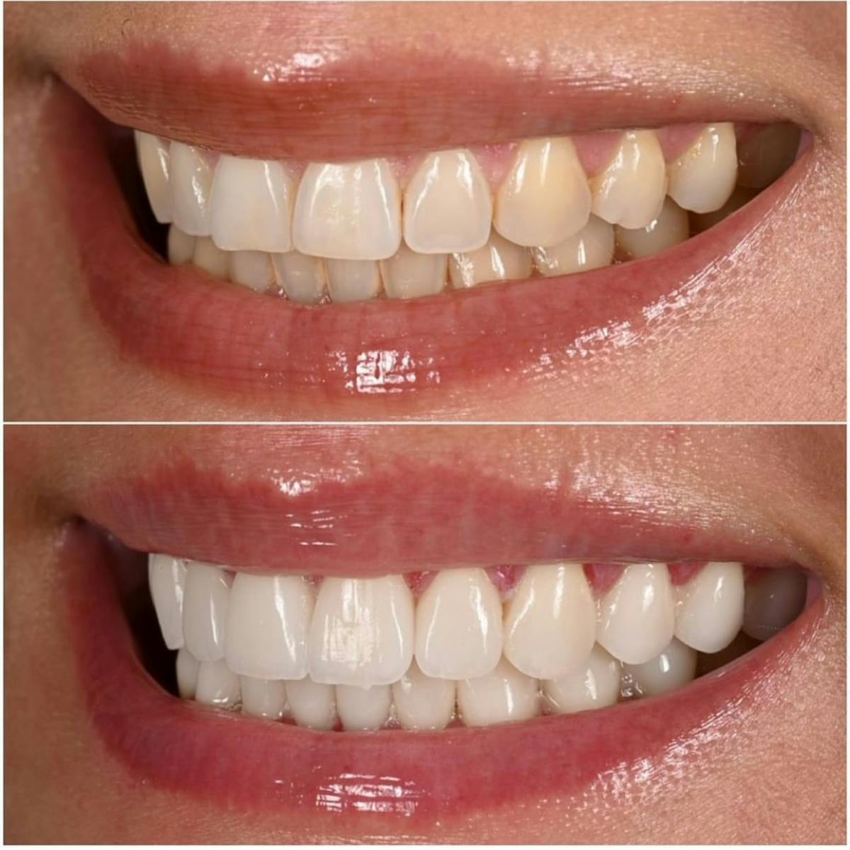 Smile Makeover Before & After Gallery - Patient 334037 - Image 1