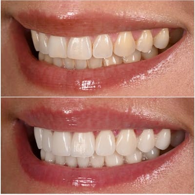 Smile Makeover Before & After Gallery - Patient 334037 - Image 1