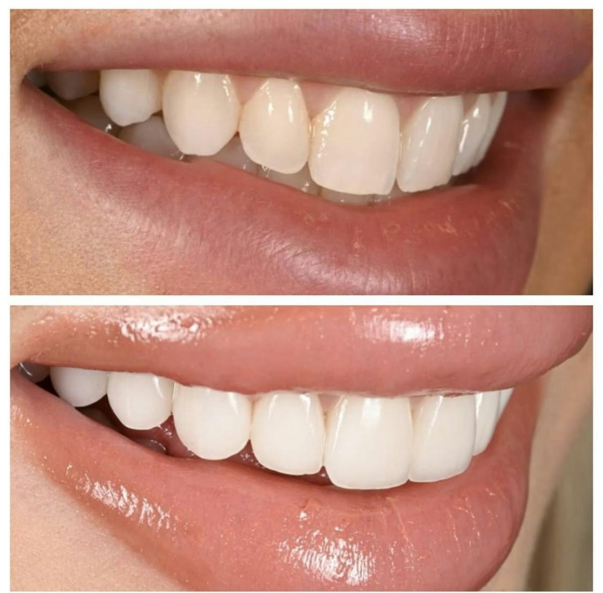 Smile Makeover Before & After Gallery - Patient 412265 - Image 1