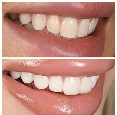 Smile Makeover Before & After Gallery - Patient 412265 - Image 1