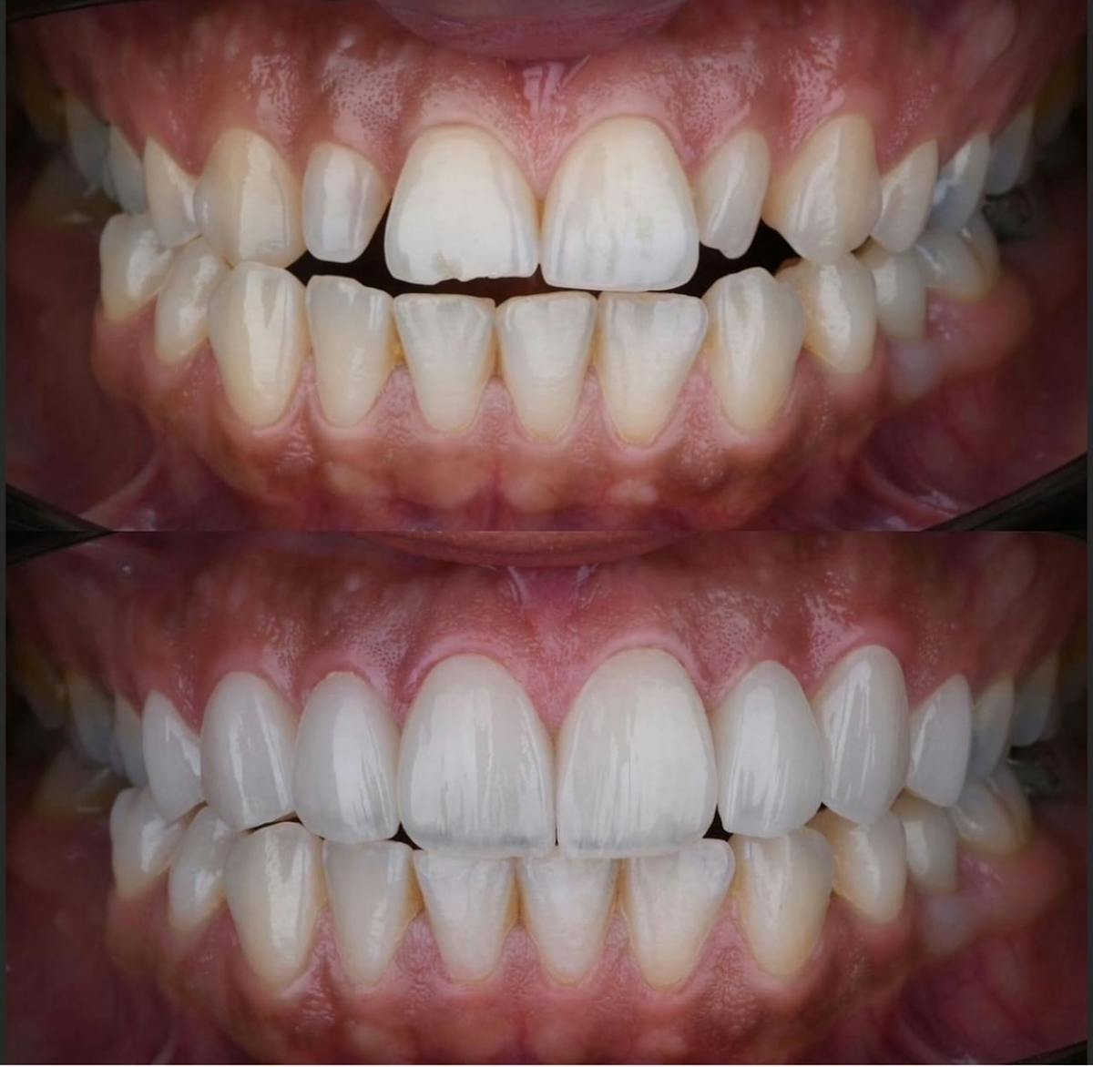 Smile Makeover Before & After Gallery - Patient 263570 - Image 1