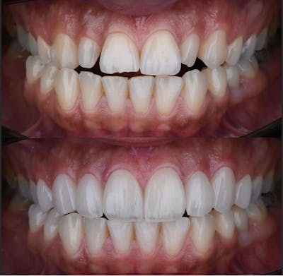 Smile Makeover Before & After Gallery - Patient 263570 - Image 1