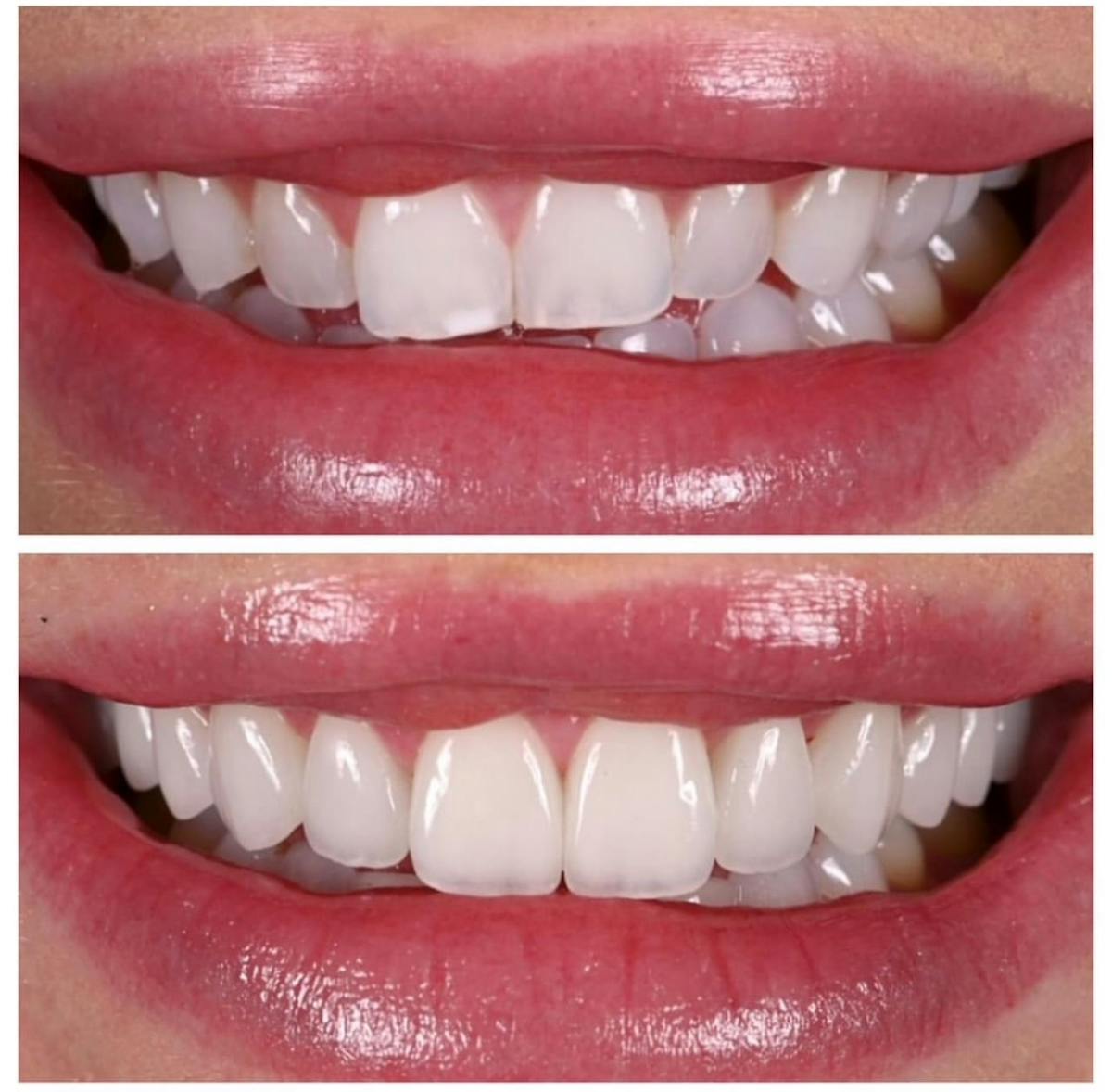 Smile Makeover Before & After Gallery - Patient 121030 - Image 1