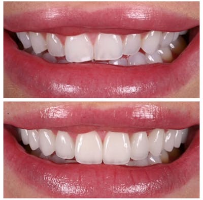 Smile Makeover Before & After Gallery - Patient 121030 - Image 1