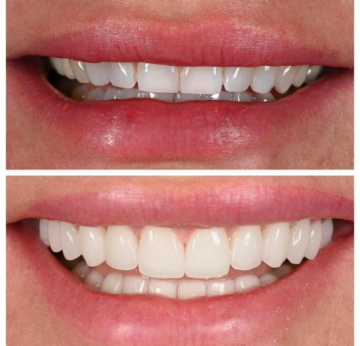Smile Makeover Before & After Gallery - Patient 638472 - Image 1