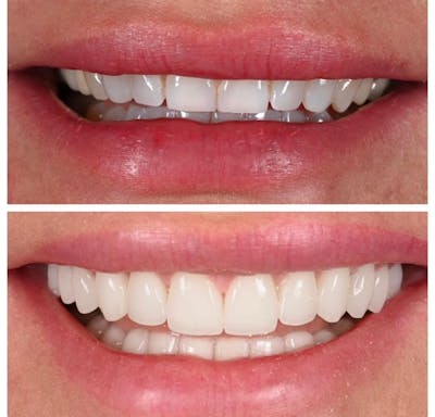 Smile Makeover Before & After Gallery - Patient 638472 - Image 1