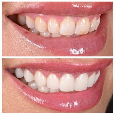 Smile Makeover Before & After Gallery - Patient 327255 - Image 1