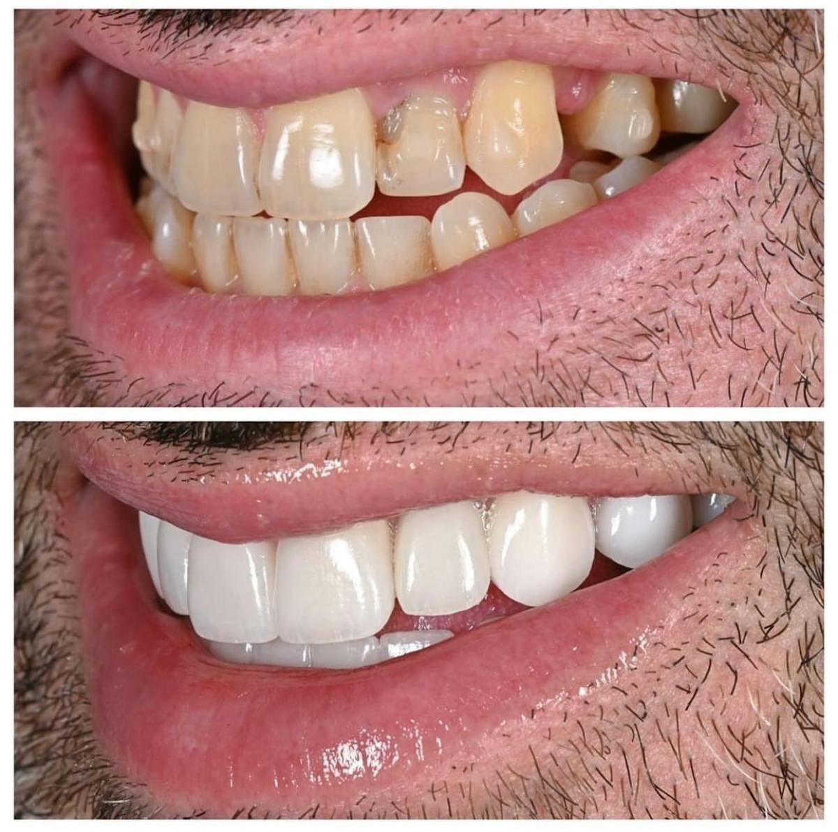 Smile Makeover Before & After Gallery - Patient 344367 - Image 3