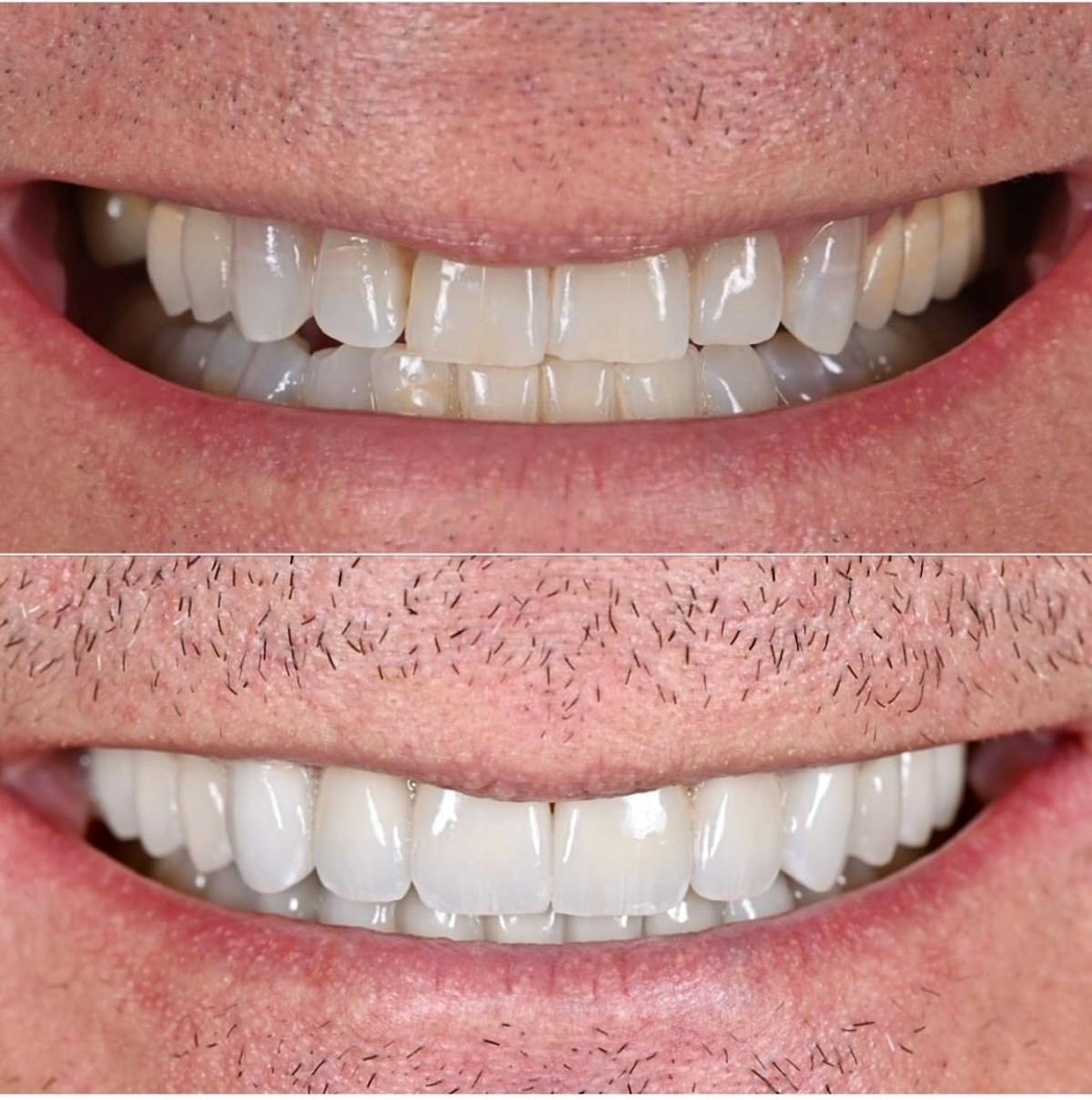 Smile Makeover Before & After Gallery - Patient 409706 - Image 1