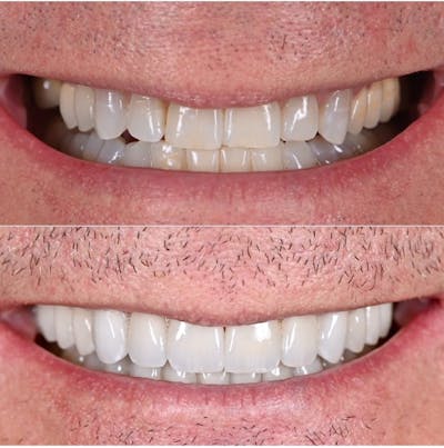 Smile Makeover Before & After Gallery - Patient 409706 - Image 1