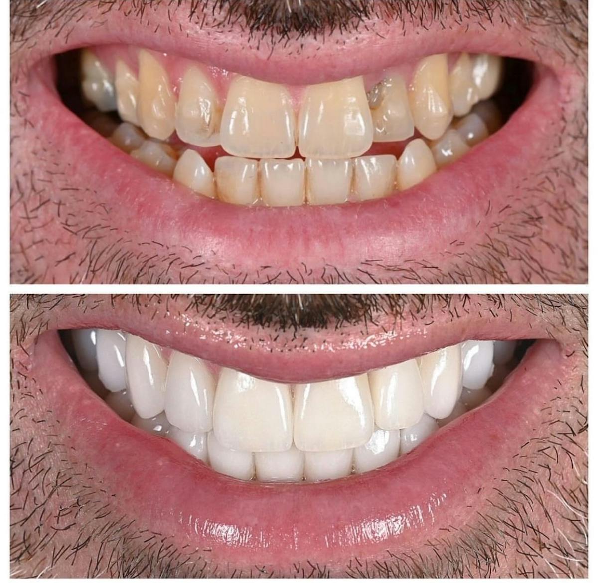 Smile Makeover Before & After Gallery - Patient 344367 - Image 2