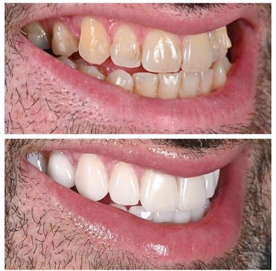 Smile Makeover Before & After Gallery - Patient 344367 - Image 1