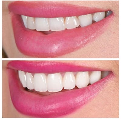 Smile Makeover Before & After Gallery - Patient 159974 - Image 1