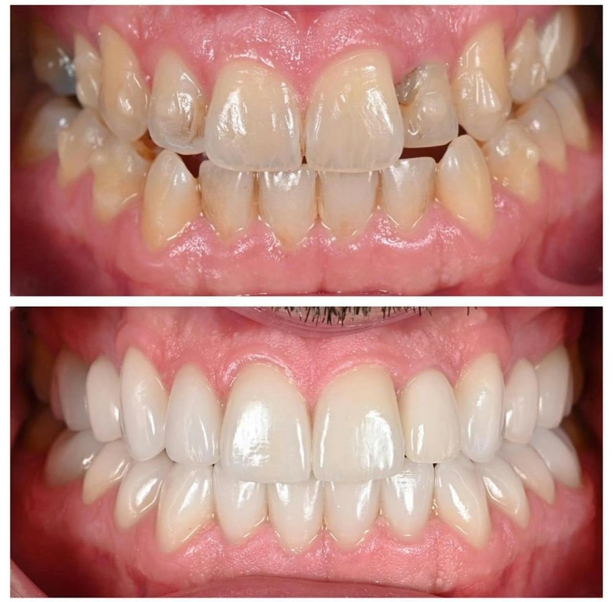 Smile Makeover Before & After Gallery - Patient 344367 - Image 5