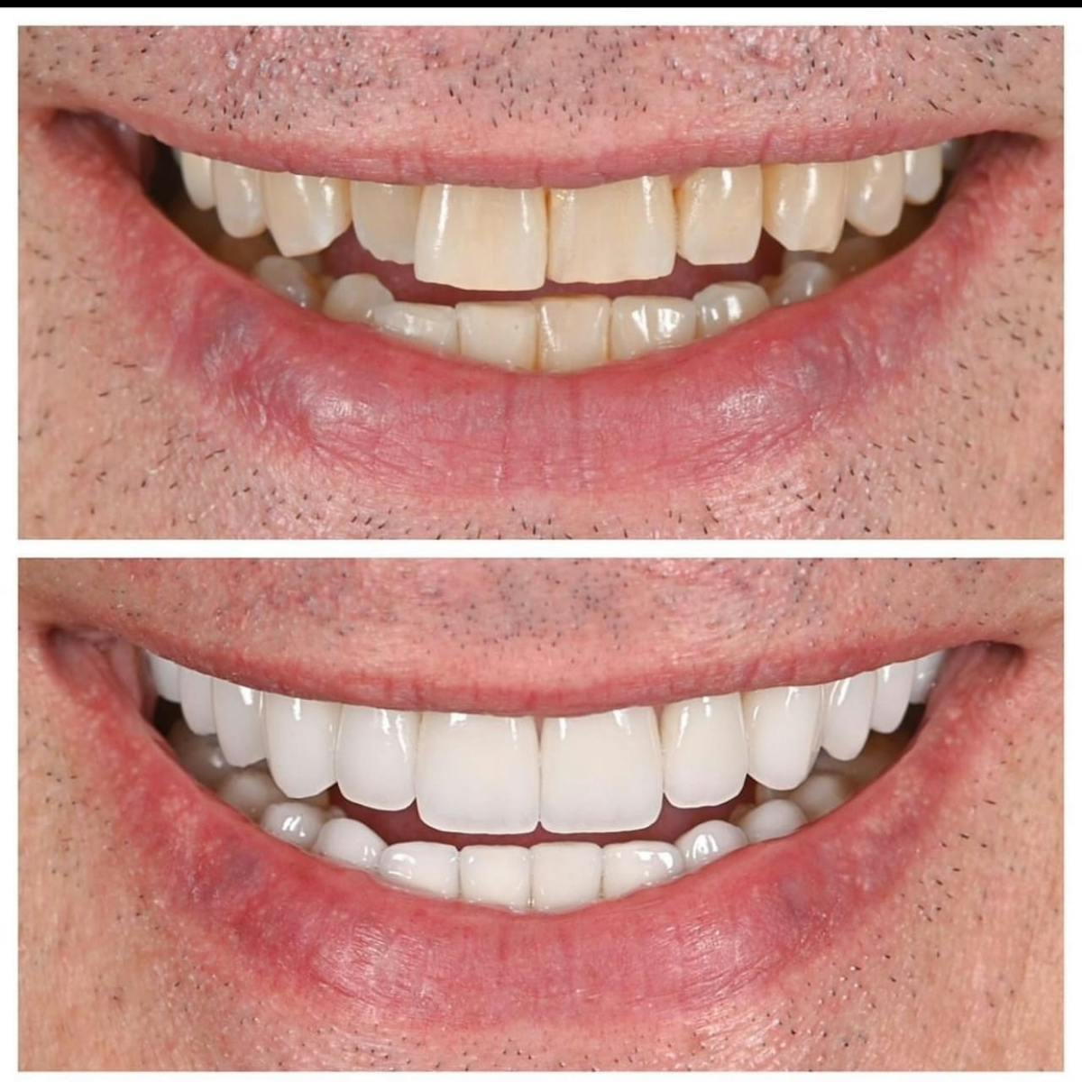 Smile Makeover Before & After Gallery - Patient 136920 - Image 1
