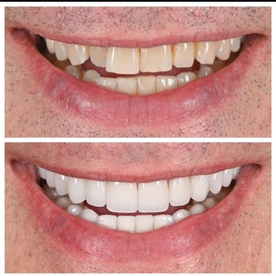 Smile Makeover Before & After Gallery - Patient 136920 - Image 1