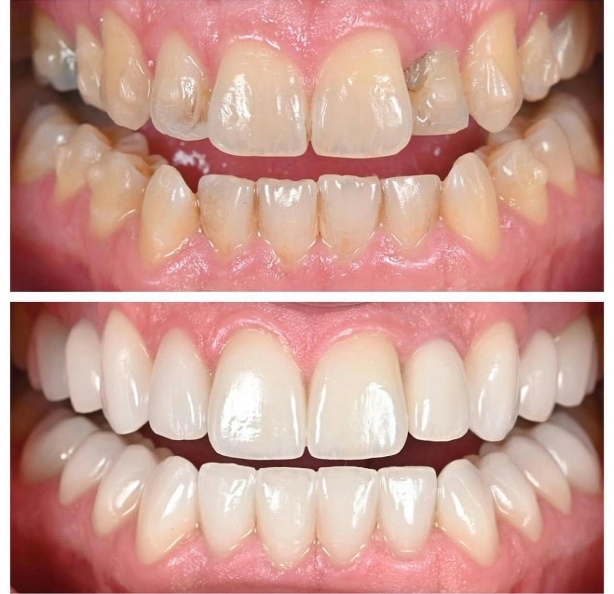 Smile Makeover Before & After Gallery - Patient 344367 - Image 4