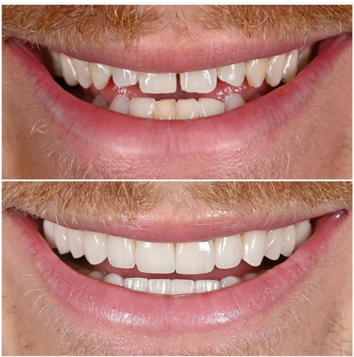 Smile Makeover Before & After Gallery - Patient 324397 - Image 2