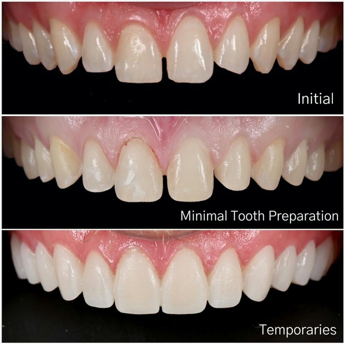 Smile Makeover Before & After Gallery - Patient 324397 - Image 1