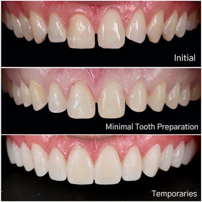 Smile Makeover Before & After Gallery - Patient 324397 - Image 1