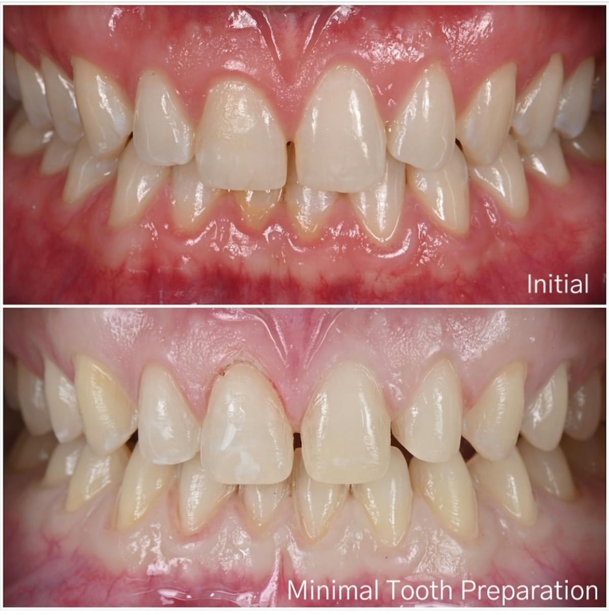 Smile Makeover Before & After Gallery - Patient 324397 - Image 4