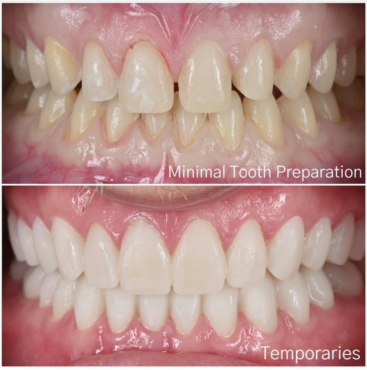 Smile Makeover Before & After Gallery - Patient 324397 - Image 5
