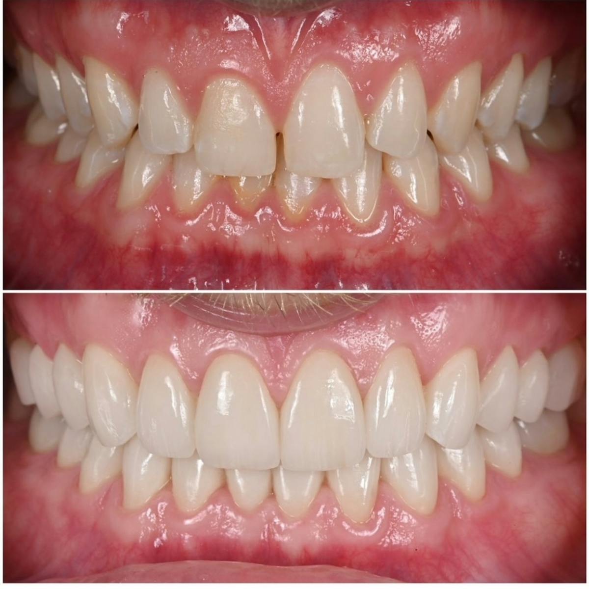 Smile Makeover Before & After Gallery - Patient 324397 - Image 6