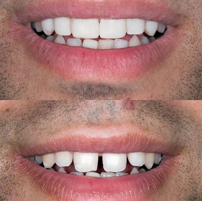 Smile Makeover  Before & After Gallery - Patient 114556 - Image 1