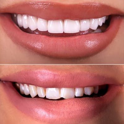 Smile Makeover  Before & After Gallery - Patient 113856 - Image 1