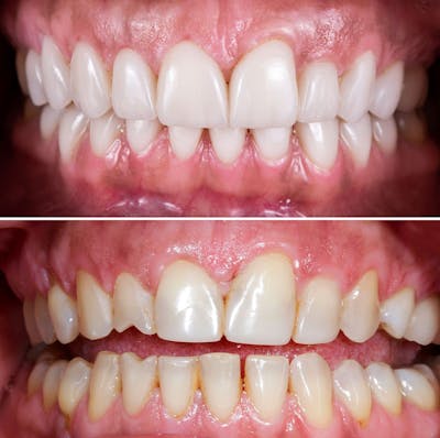 Smile Makeover  Before & After Gallery - Patient 501586 - Image 1