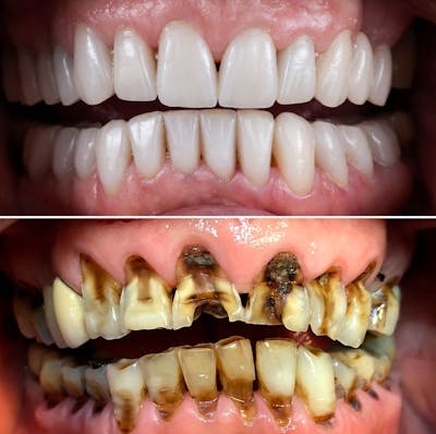 Smile Makeover  Before & After Gallery - Patient 299792 - Image 1
