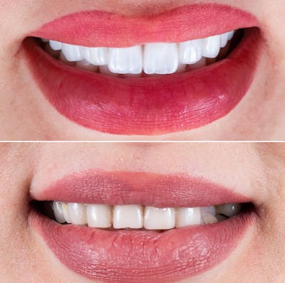 Smile Makeover  Before & After Gallery - Patient 385342 - Image 1