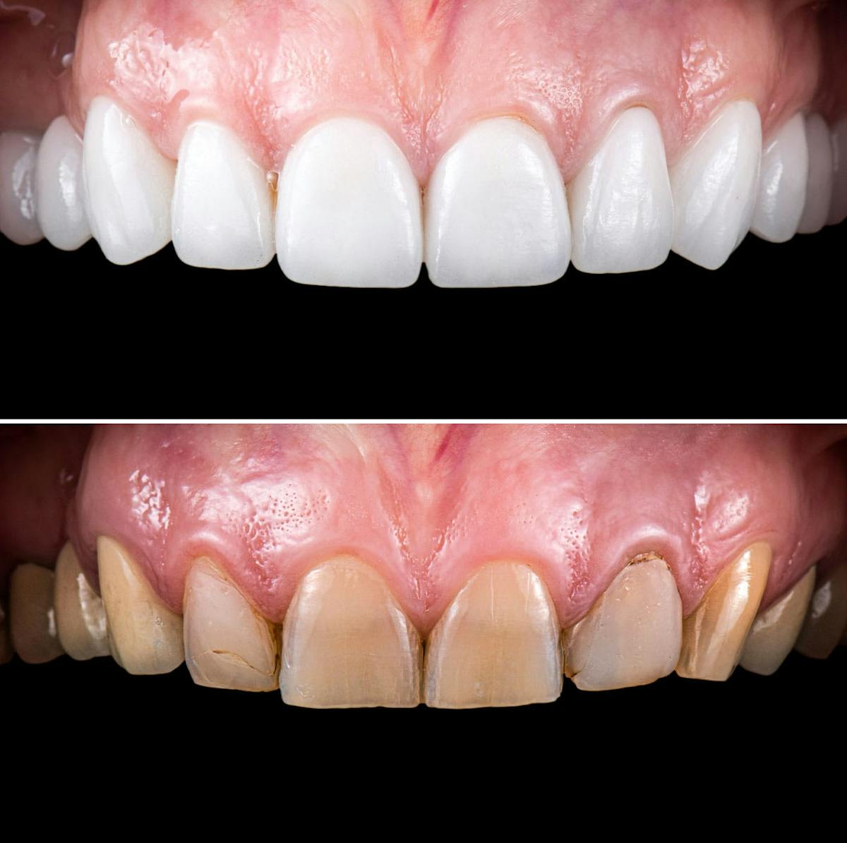 Smile Makeover  Before & After Gallery - Patient 304805 - Image 1
