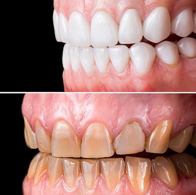 Smile Makeover  Before & After Gallery - Patient 307286 - Image 1