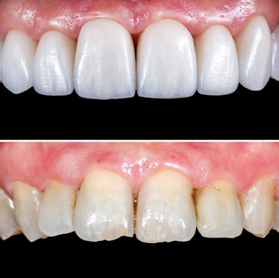 Smile Makeover  Before & After Gallery - Patient 965637 - Image 1