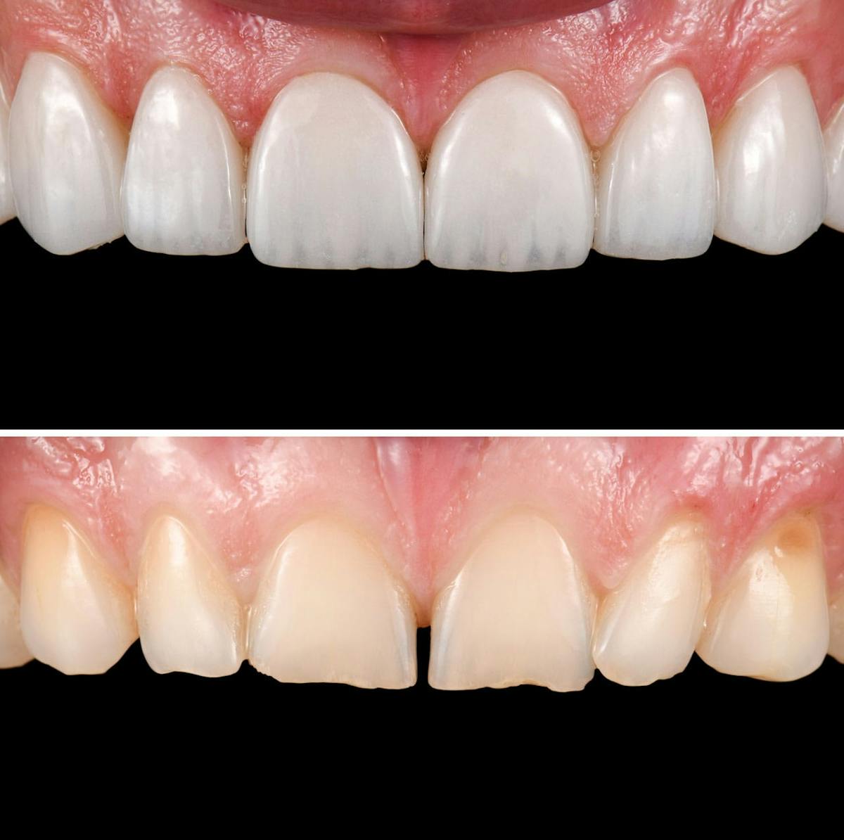 Smile Makeover  Before & After Gallery - Patient 284744 - Image 1