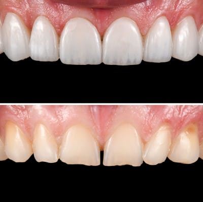 Smile Makeover  Before & After Gallery - Patient 284744 - Image 1
